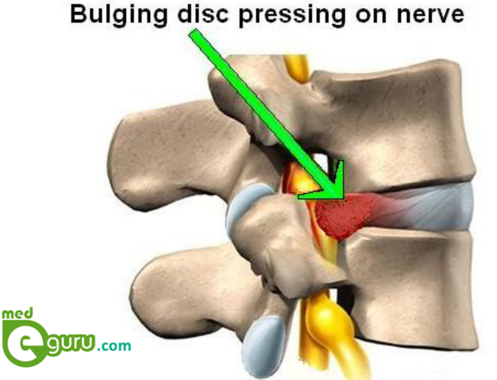 What is a Bulging Disc?