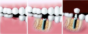 dental-implant-procedure