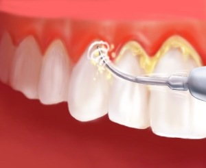 dental-plaque-medeguru