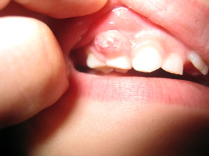 tooth-abscess-medeguru
