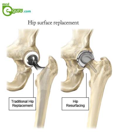 Hip surface replacement surgery