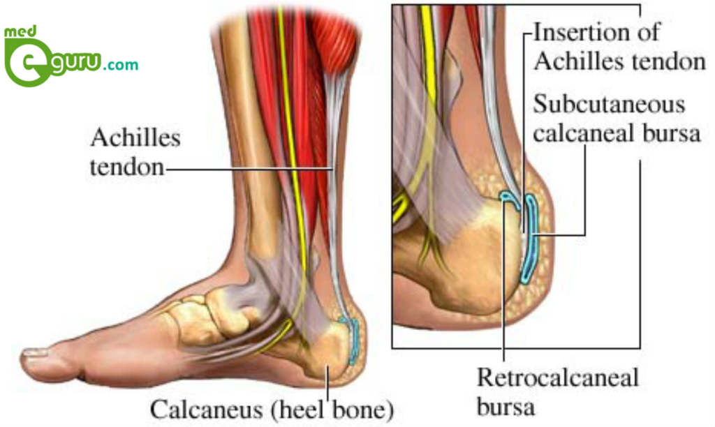 Achilles Tendinitis