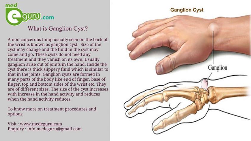 Cyst ganglion cure for How to