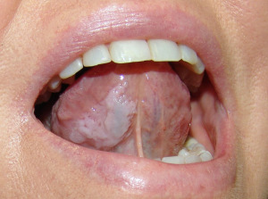 leukoplakia-medeguru