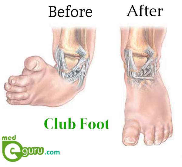 Club Foot diagram Medeguru