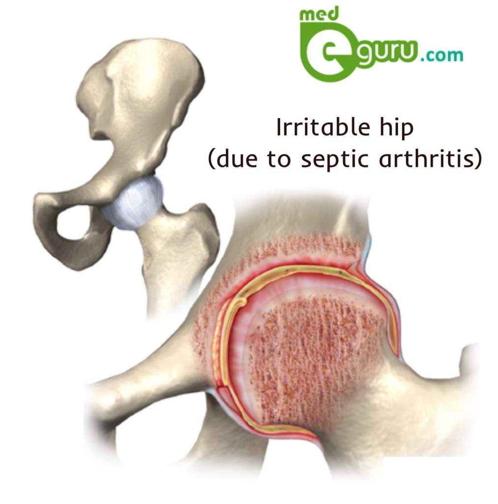 Irritable hip septic arthritis