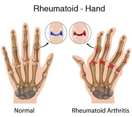 Rheumatologist in India