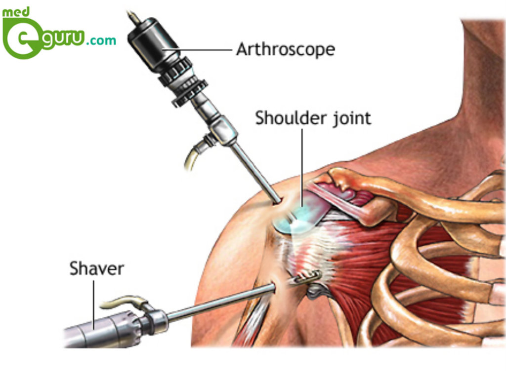 Shoulder Arthroscopy