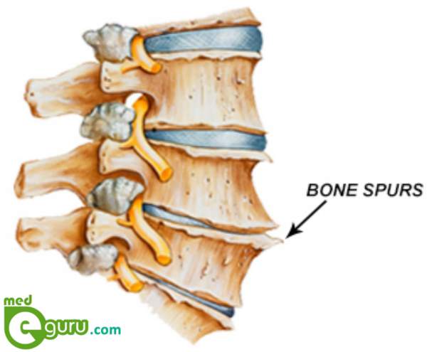 bone spur on spine