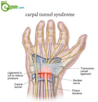 what is Carpal Tunnel Syndrome