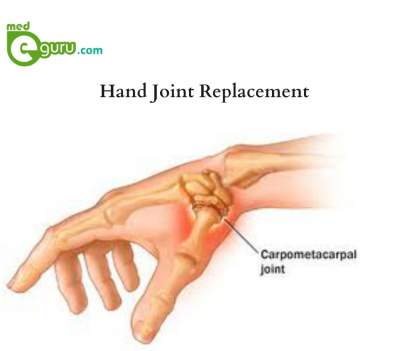 Hand Joint Replacement
