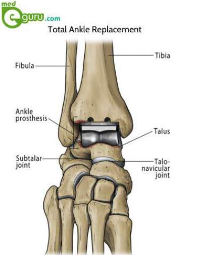 Total Ankle Replacement Surgery