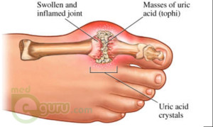 What is gout