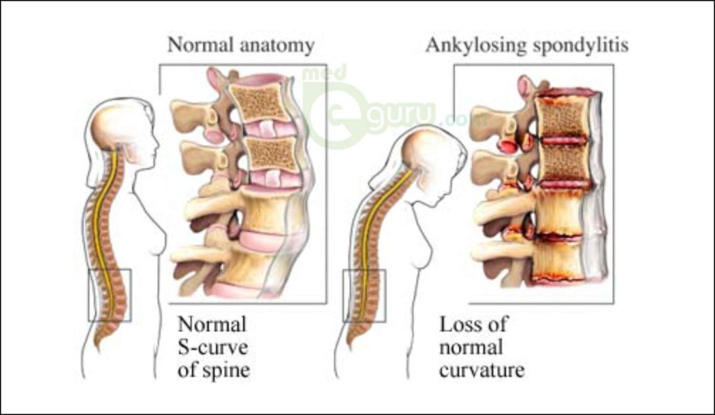 What is Ankylosing Spondylitis